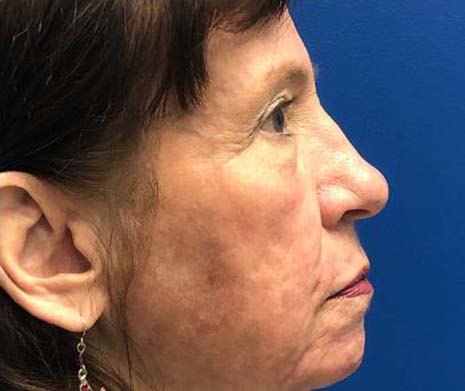 Mixto C02 Laser Resurfacing