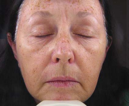 Photofacial / IPL