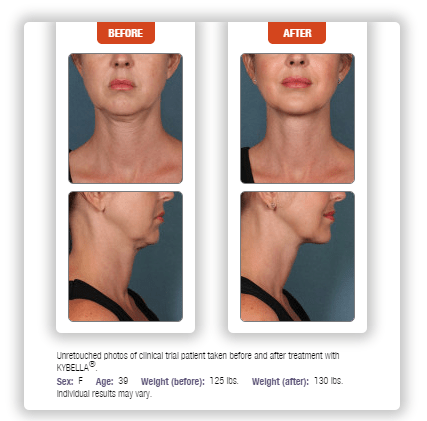 Kybella