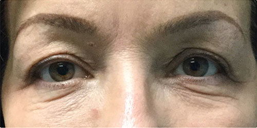 Upper Blepharoplasty