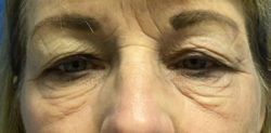 Upper Blepharoplasty