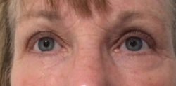 Upper Blepharoplasty