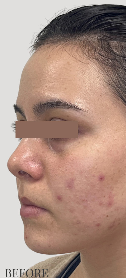 RF Microneedling