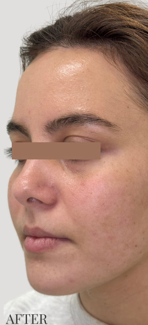 RF Microneedling