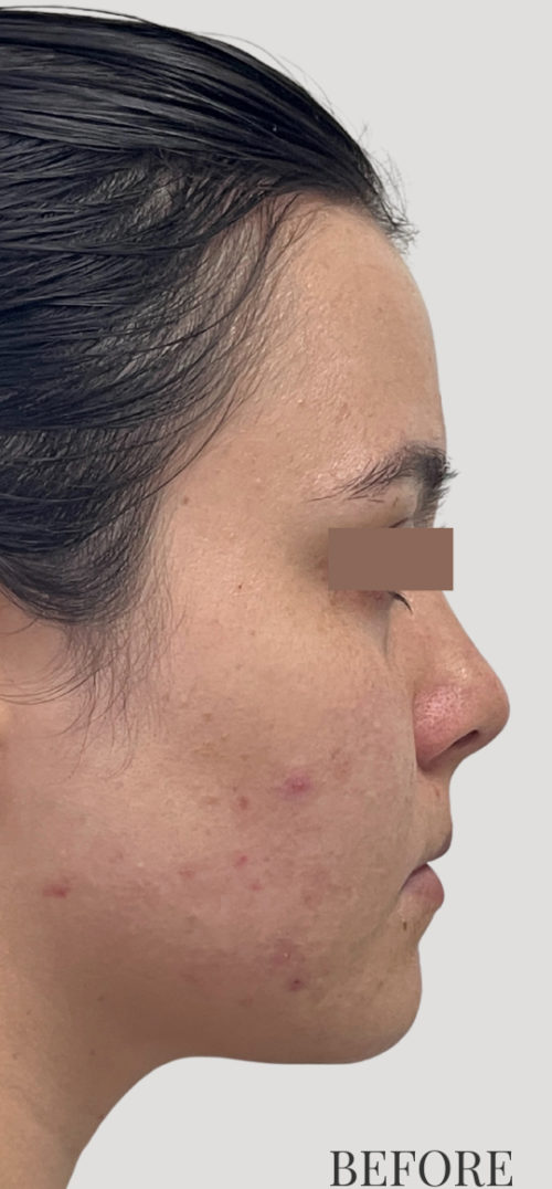 RF Microneedling