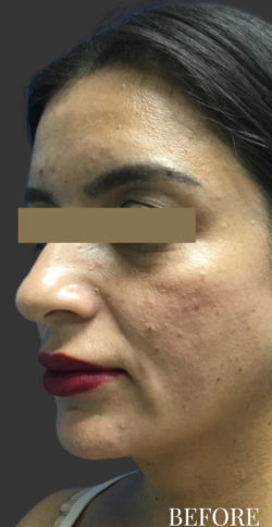 Mixto C02 Laser Resurfacing