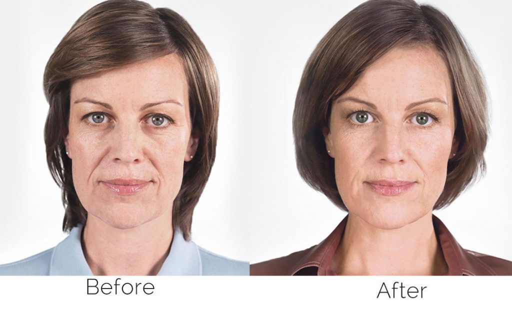 Sculptra Before and After Results