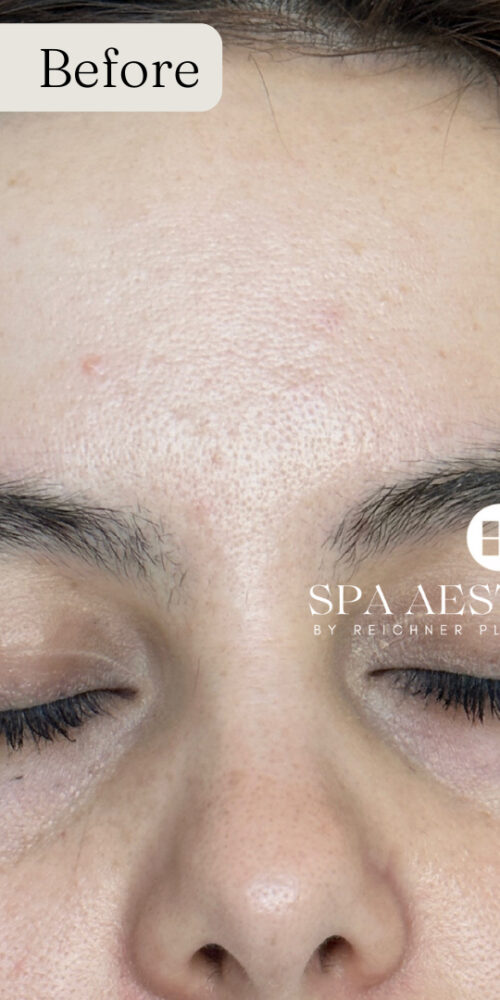 RF Microneedling