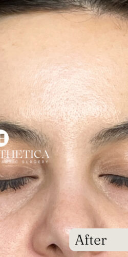 RF Microneedling