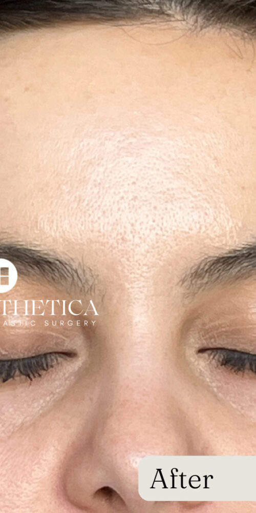 RF Microneedling