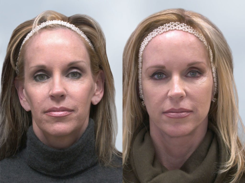 Sculptra Before and After Results