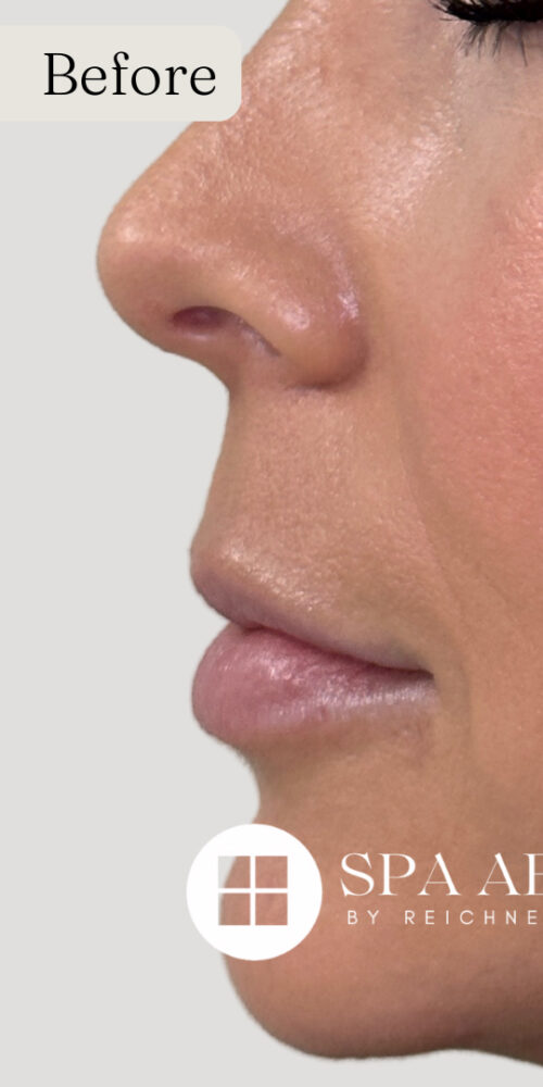 Restylane Filler