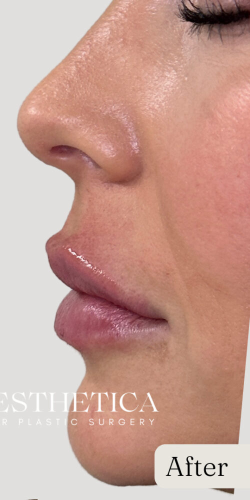 Restylane Filler