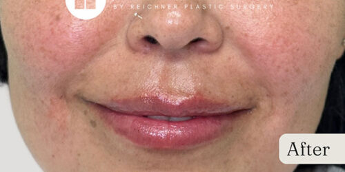 Versa Filler Case 11087 After Photo Versa Filler