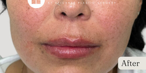 Versa Filler Case 11087 After Photo Versa Filler