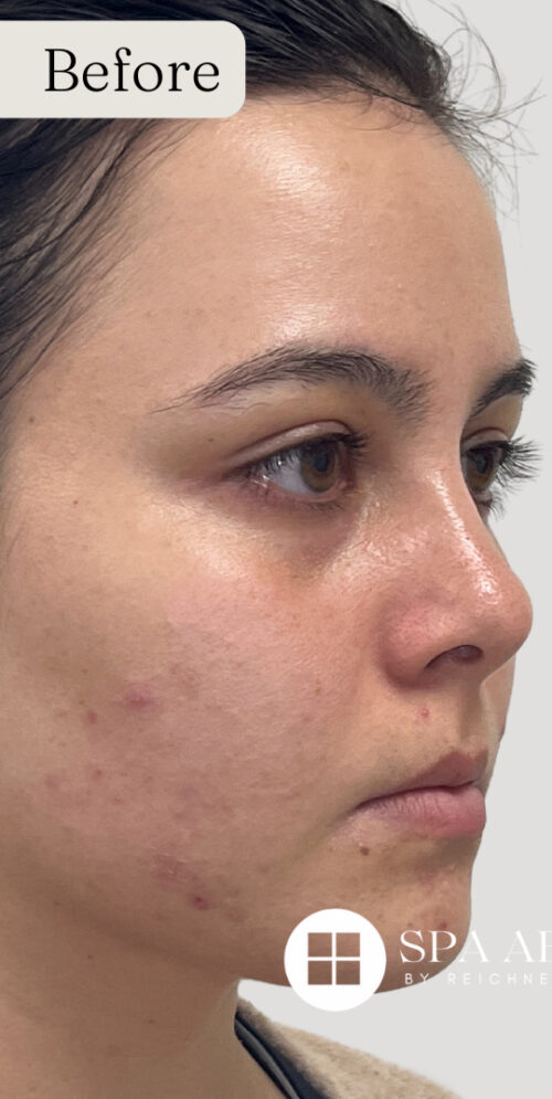 Mixto C02 Laser Resurfacing Case 11088 Before Photo Mixto C02 Laser Resurfacing