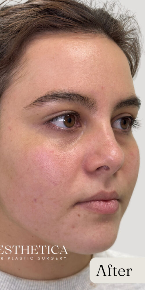 Mixto C02 Laser Resurfacing Case 11088 After Photo Mixto C02 Laser Resurfacing