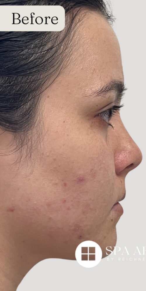 Mixto C02 Laser Resurfacing Case 11088 Before Photo Mixto C02 Laser Resurfacing