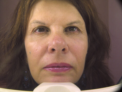 Laser Resurfacing Results Orange County