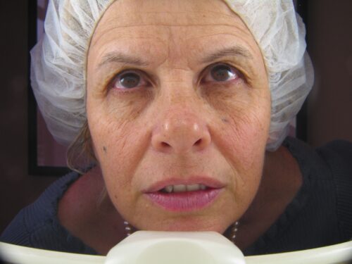 Laser Resurfacing Orange County