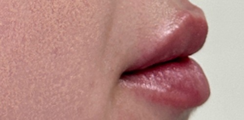RHA Filler