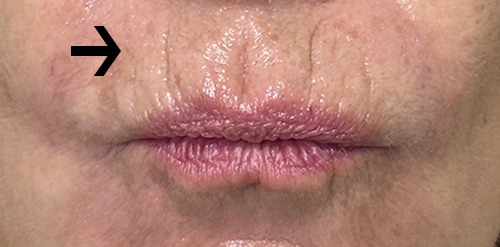 RHA Filler Case 15114 Before Photo RHA Filler
