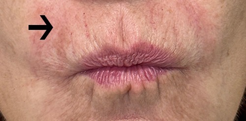 RHA Filler Case 15114 After Photo RHA Filler