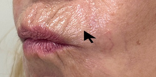 RHA Filler Case 15114 Before Photo RHA Filler