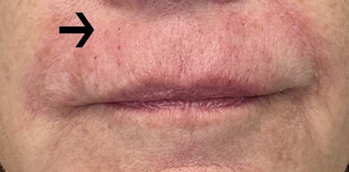 RHA Filler Case 15114 After Photo RHA Filler