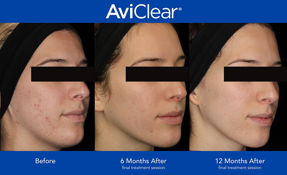 AviClear Before & After Photo