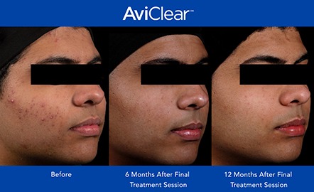 AviClear Before & After Photo