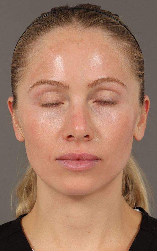 RF Microneedling