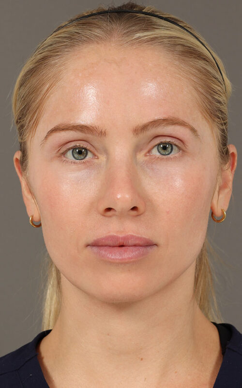 RF Microneedling
