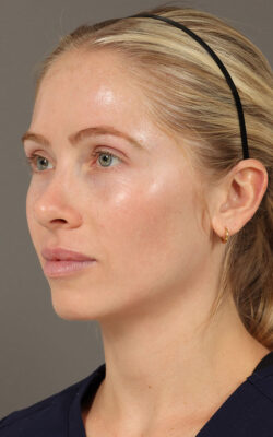 RF Microneedling
