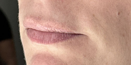 RHA Filler