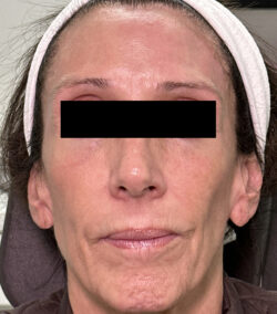 Mixto CO2 Laser Resurfacing