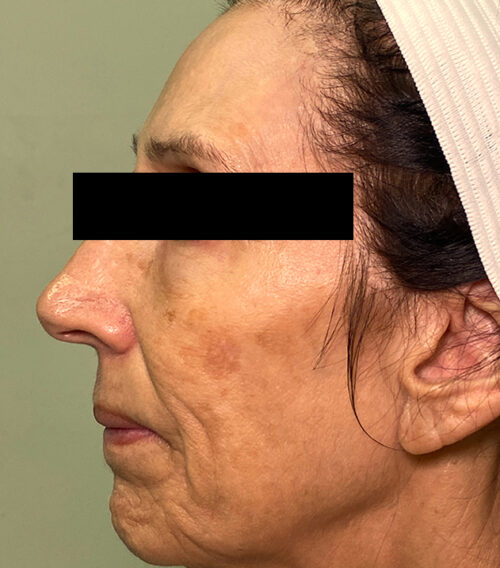 Mixto CO2 Laser Resurfacing