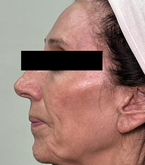 Mixto CO2 Laser Resurfacing