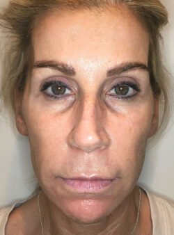 Sculptra Aesthetic