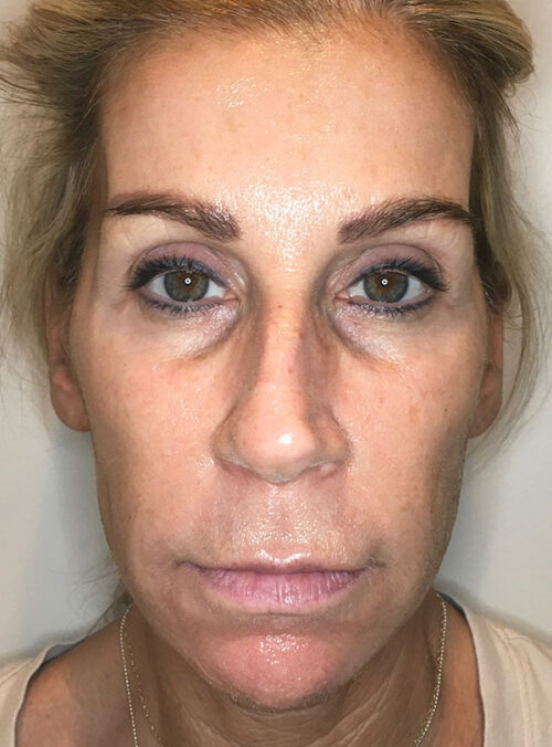Sculptra Aesthetic