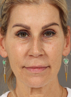 Sculptra Aesthetic