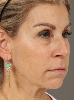 Sculptra Aesthetic