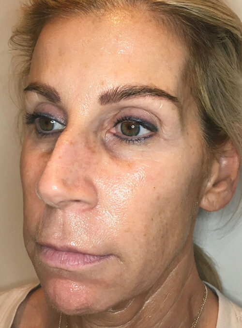 Sculptra Aesthetic